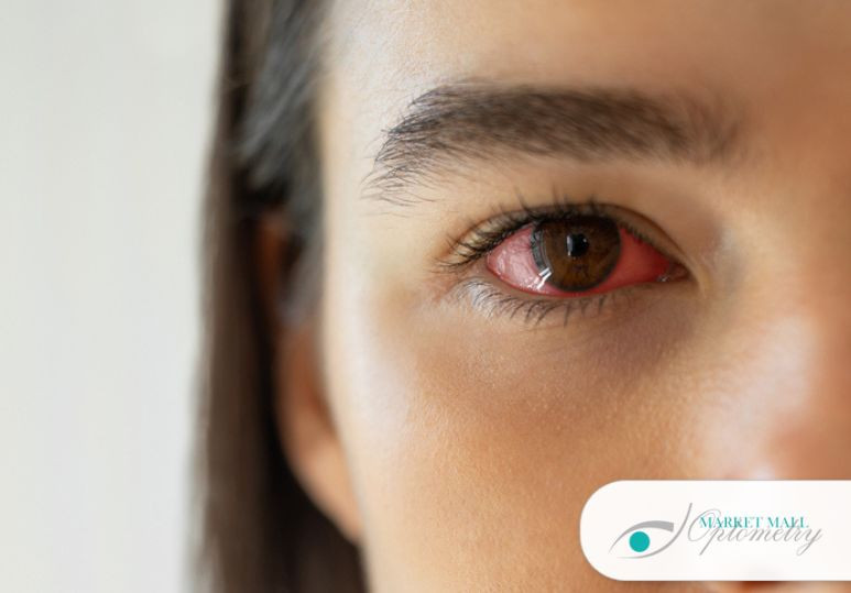 Can Changes In My Diet Relieve Dry Eye Syndrome? | Calgary Optometrist